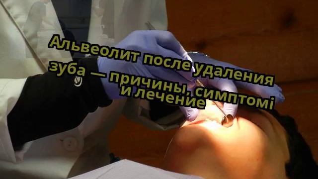 Альвеолит после удаления зуба — причины, симптомі и лечение