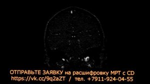 ГИПОПЛАЗИЯ поперечного синуса на расшифровке МРТ синусов головного мозга