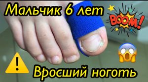 Мальчик 6 лет⚠️?❗️ • Вросший ноготь??⚠️?