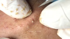 Suri Job 53: A BEST BLACKHEADS FIELD
