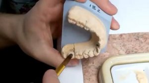 металлокерамика  на имплантах винтовая фиксация.