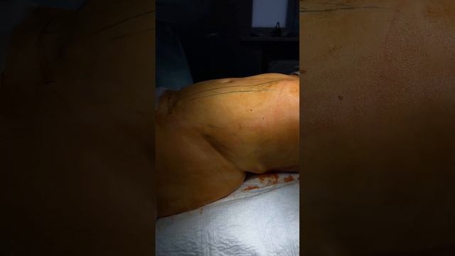 Липоабдоминопластика + липоскульптура живота и боков + липосакция поясницы 🔥👌🏽