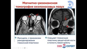 МРТ придаточных пазух носа
