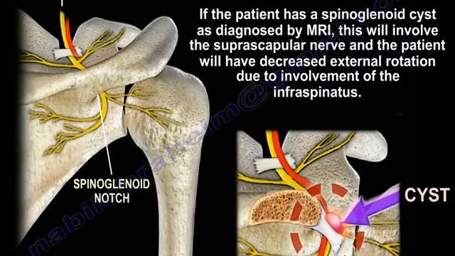 Lesions Of The Shoulder SLAP Tear - Everything You Need To Know - Dr. Nabil Ebraheim смотреть онлайн