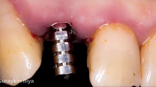 Одномоментная имплантация зуба , имплантация зубов. Удаление зуба , лечение зубов , сурайкин Илья смотреть онлайн