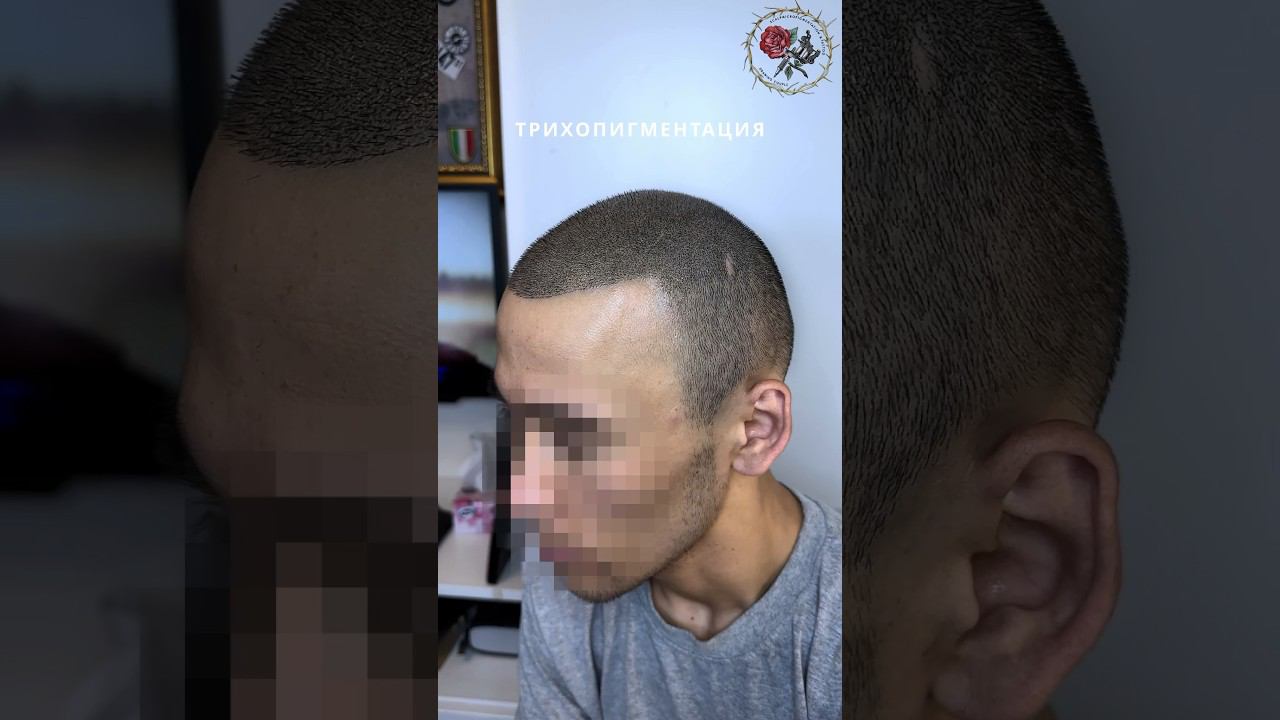 Трихопигментация по методу «прямые руки», загущение после пересадки волос, Scalp tattoo SMP