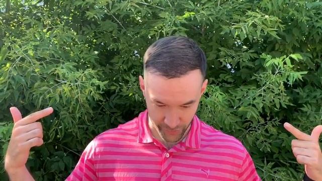 Результат пересадки волос через 6 месяцев. Марат из России. смотреть онлайн