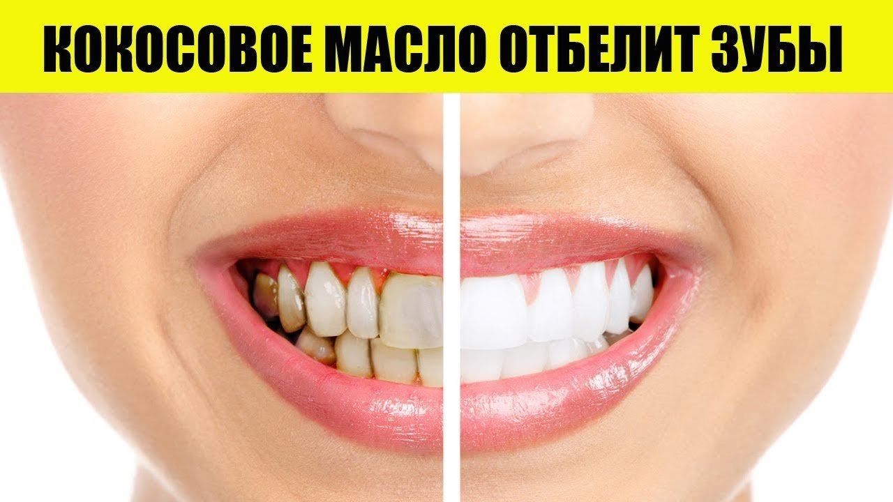 Зубы желтый чистить. Отбеливание зубов кокосовым маслом.