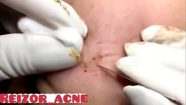 Removes acne, Давим прыщи, чёрные точки. Залипательно 2021 смотреть онлайн