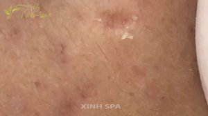 Blackhead removal and Acne Treatment for Nguyen Van Quoc Come back from Canada