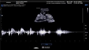 13 WEEK ULTRASOUND FOR BRITTANY