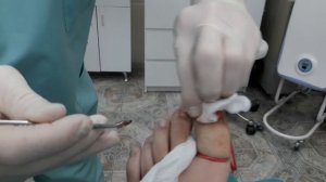 Удаление вросшего ногтя с двух сторон пальца с применением радиоволны