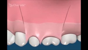 Как сохранить зуб с отломом корня в моляре  Хирургическая стоматология  Гемисекция