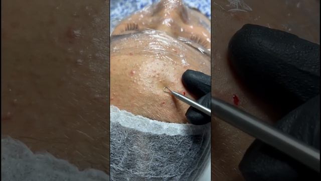 Чистка лица #косметология #косметика #ташкент #увеличениегуб #уход #уходзакожей #эстетика #чистка смотреть онлайн