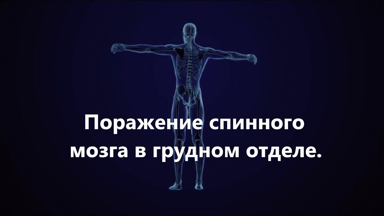 Нейрореабилитация.  Нижняя параплегия.  Базовая стратегия.