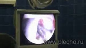 Артроскопия плеча