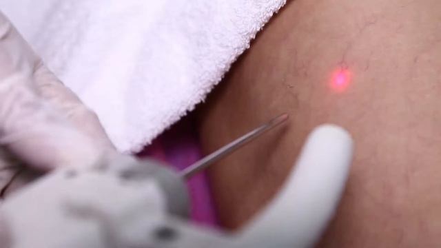 ЛАЗЕРНОЕ УДАЛЕНИЕ СОСУДОВ [aristo.studio] смотреть онлайн