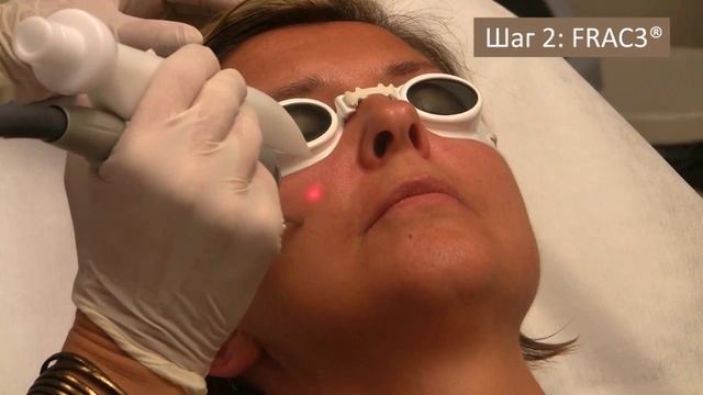 Fotona 4D - неинвазивный лазерный фейс-лифтинг смотреть онлайн