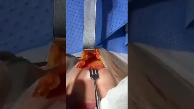 Центральная платизмопластика или липосакция