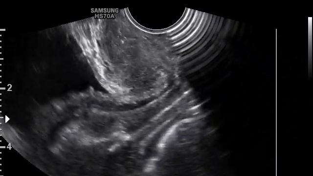 ДИАГНОСТИКА ПРОЛАПСА ГЕНИТАЛИЙ смотреть онлайн