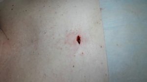 Удаление липомы с наложением швов по Альговеру
