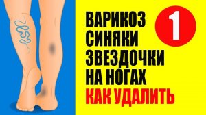 Варикоз, Синяки, Сосудистые Звездочки на ногах. Как лечить 1