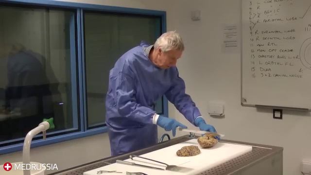 Сравнение здорового мозга и мозга с Альцгеймером. смотреть онлайн