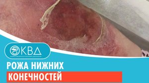 ? Рожа нижних конечностей. Клинический случай №913