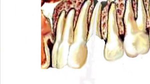 Периодонтит