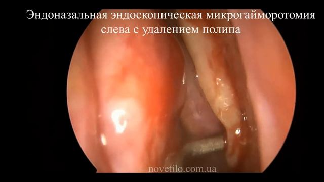 Рассечение синехий полости носа с удалением полипа левой гайморовой пазухи