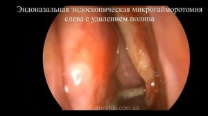 Рассечение синехий полости носа с удалением полипа левой гайморовой пазухи