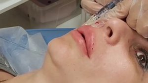 АирисКом студенты учатся: коррекция губ филлером, исправление ассиметрии.