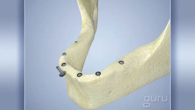 протез на имплантах ,микрозамковая фиксация смотреть онлайн