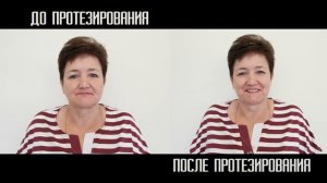 Изготовление полных съёмных эстетических протезов