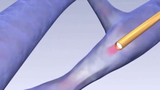 Эндоваскулярная лазерная коагуляция (ЭВЛК) или эндовазальная лазерная абляция