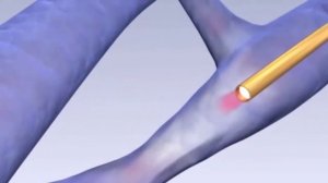 Эндоваскулярная лазерная коагуляция (ЭВЛК) или эндовазальная лазерная абляция