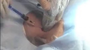 Катетеризация яремной вены