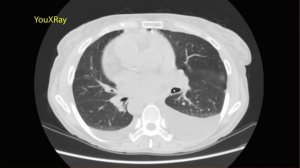 Транспозиция внутренних органов на КТ