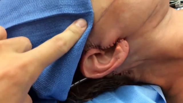 Lower Facelift - Lifting the Face and Neck - Before and After - Dr. Anthony Youn смотреть онлайн