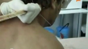 Пробило голову деревяшкой