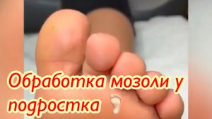 Обработка мозоли??