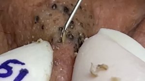 Happy Life With Blackheads & Acne Treatment 228