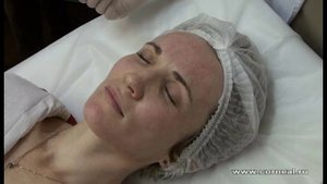 Одна из немногих процедур показанная при куперозе