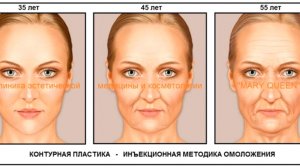 Контурная пластика лица. Инъекции гиалуроновой кислоты.  Эстетическая медицина и косметология. 