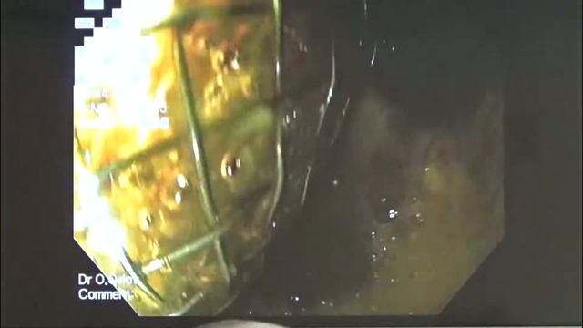 03 Орлов ОЮ Осложнения стентирования пищевода и методы их Эндоскопического лечения смотреть онлайн