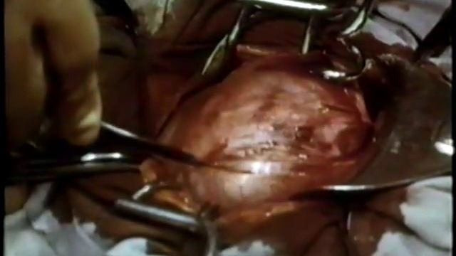 Миома матки, МИОМЭКТОМИЯ © Conservative myomectomy