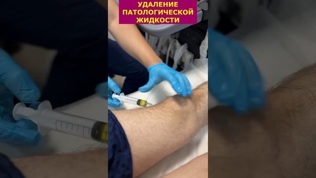 Лечение синовита коленного сустава смотреть онлайн