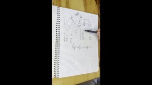 ЭКГ. Определение места возникновения желудочковых экстрасистол