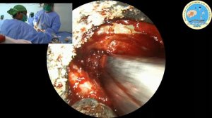 Lt. L 4/5 endoscopic disocectomy & canal decompression.