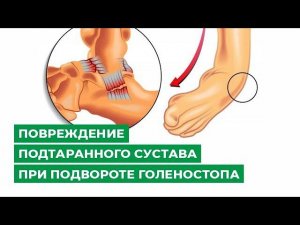 Повреждение подтаранного сустава при подвороте голеностопа